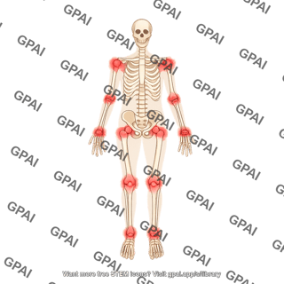 Rheumatoid arthritis in joints human skeleton anterior