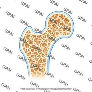Femur proximal end cross section osteoporosis
