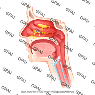 Rhinitis upper respiratory tract cross section 57