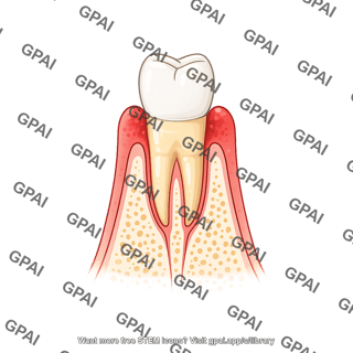 Tooth premolar gingivitis