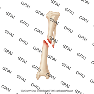 Tibial shaft fracture complete distal half anterior