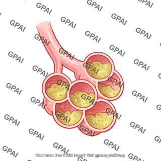 Alveoli with pneumonia