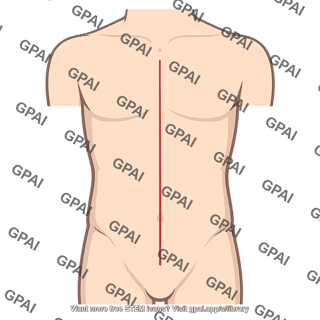 Xiphopubic incision