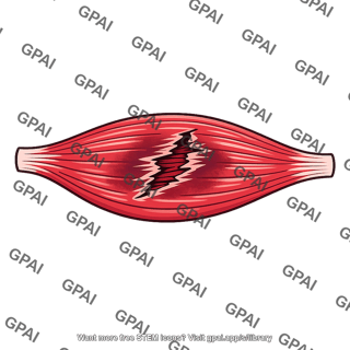 Muscle torn