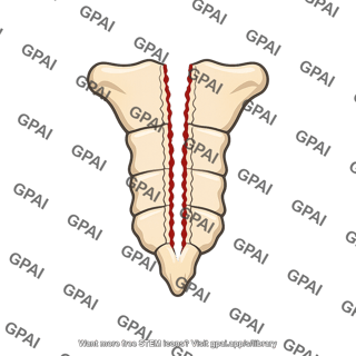 Median sternotomy
