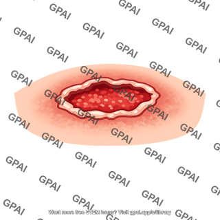 Skin ulcer