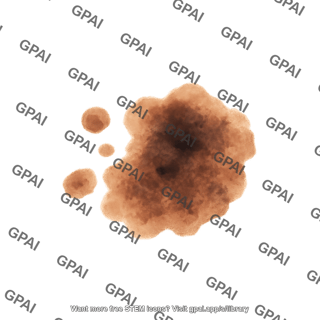 Lentigo maligna melanoma skin cancer
