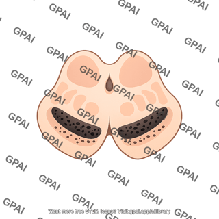Brainstem midbrain superior colliculus substantia nigra parkinsons disease