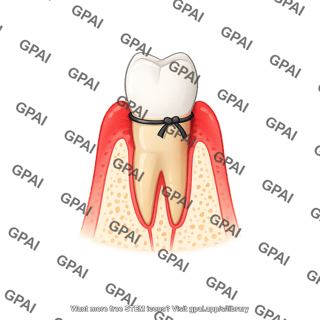 Tooth premolar gingivitis ligature