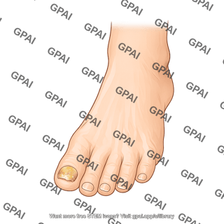 Foot onychomyosis