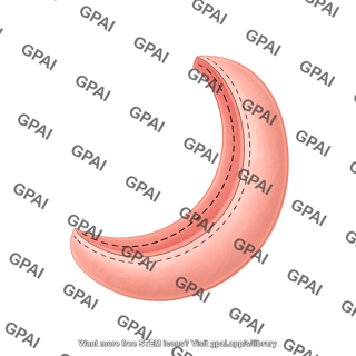 Sleeve gastrectomy removed portion of stomach