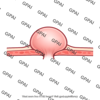 Hernia