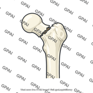 Femoral neck fractured