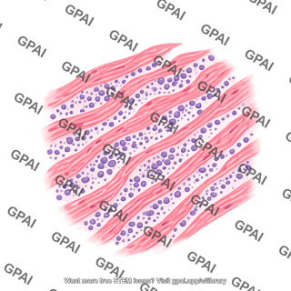 Cardiac tissue myocarditis cross section