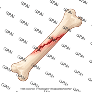 Fracture line oblique