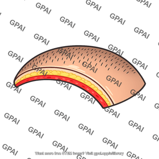 Hair bearing scalp flap