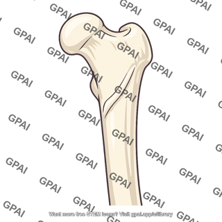 Proximal femur