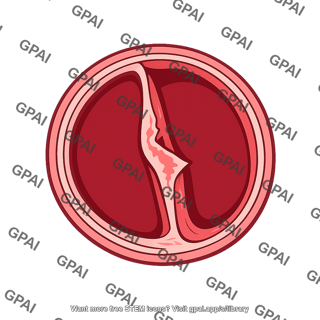 Aortic dissection cross section