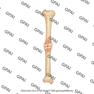 Healing bone fracture in tibia
