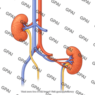 Kidney transplant