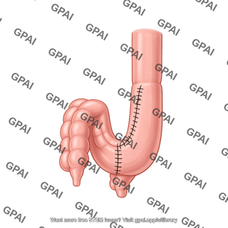 Intestines j pouch
