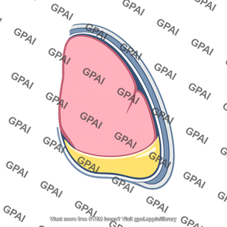 Pleural effusion