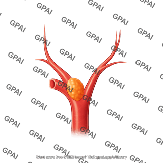 Carotid body cut