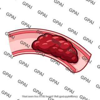 Mural thrombus