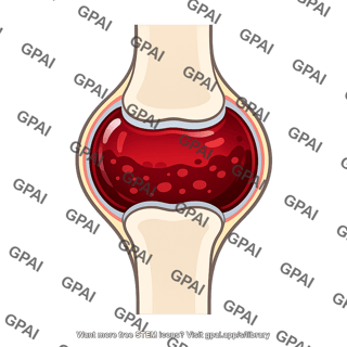 Hemarthrosis