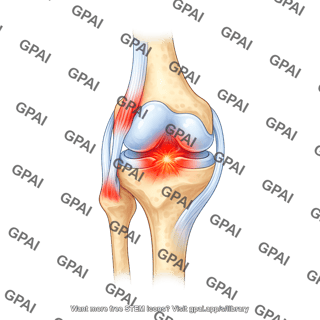 Knee joint with anterior tendons inflamed meniscus