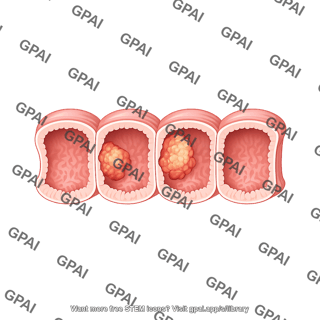 Large intestine cancer