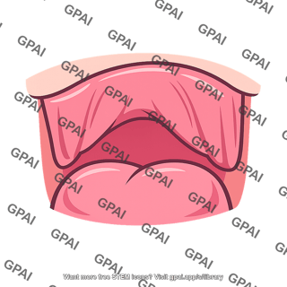 Soft palate elevated