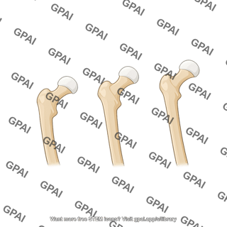 Coxa vara and valga with neck angles