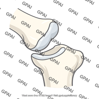 Dislocation