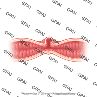 Intestinal stenosis