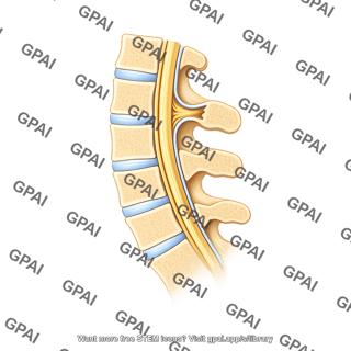 Spina bifidia occulta 1