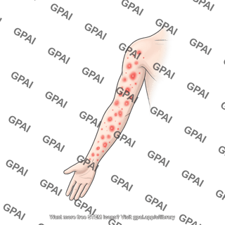 Rash generic anterior arm male