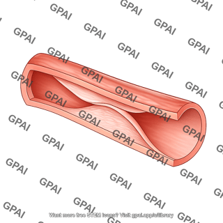 Blood vessel cut artery dissection type 2