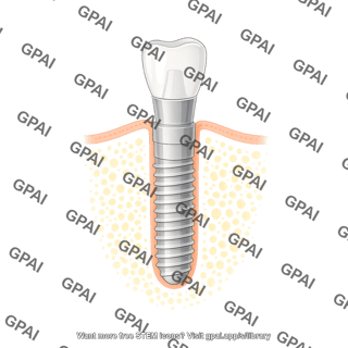 Dental implant premolar abutment