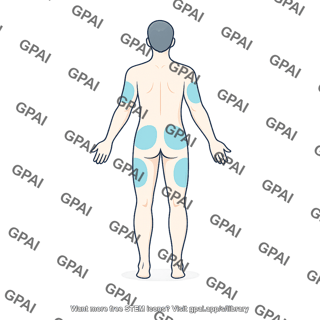 Insulin injection sites posterior