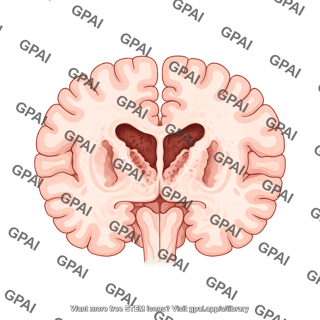 Brain coronal cut at basal ganglia huntingtons disease