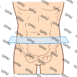 Intertubercular plane
