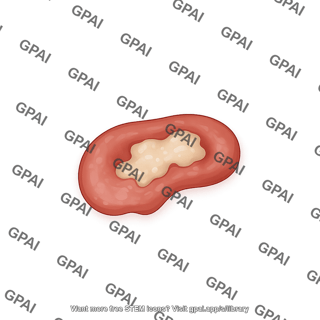 Ulcer behcet 1