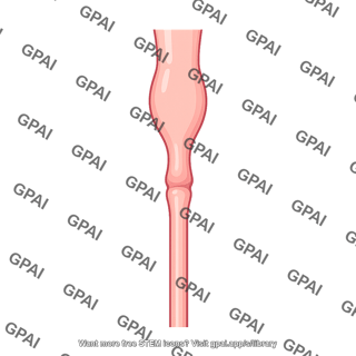 Ureter obstructed