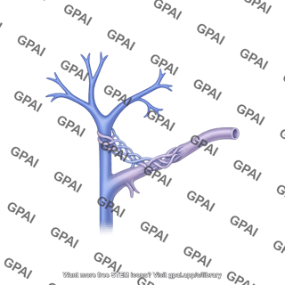 Portal vein distal splenorenal shunt