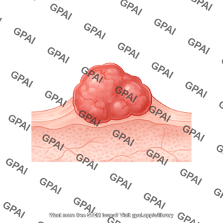 Skin cancer basal cell carcinoma