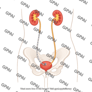 Urinary tract in abdomen female with stent