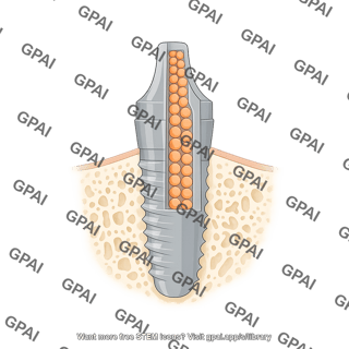 Dental implant abutment drug delivery cross section