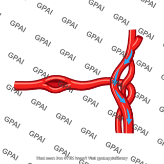 Subclavian steal syndrome