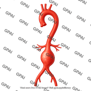Aorta with abdominal aneurysm 02